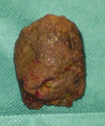 Excised phytobezoar measuring 5 x 6.1 cm (Courtesy Dr. V. Penopoulos)
