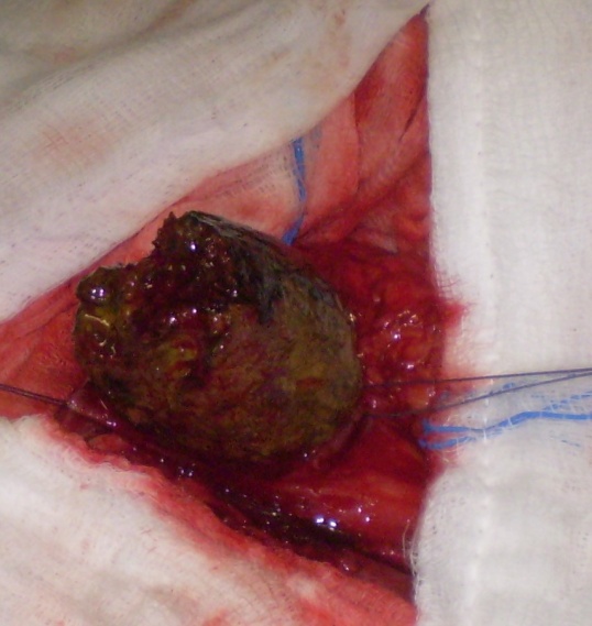 Excised phytobezoar measuring 5 x 6.1 cm (Courtesy Dr. V. Penopoulos)