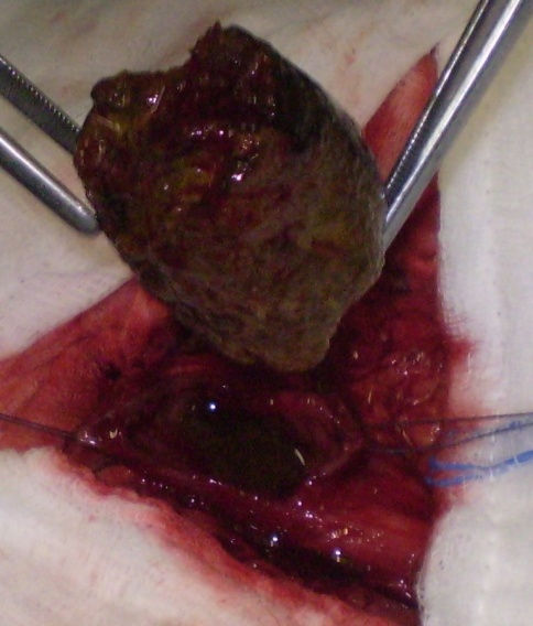 Excised phytobezoar measuring 5 x 6.1 cm (Courtesy Dr. V. Penopoulos)