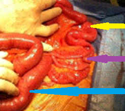 Excised phytobezoar measuring 5 x 6.1 cm (Courtesy Dr. V. Penopoulos)