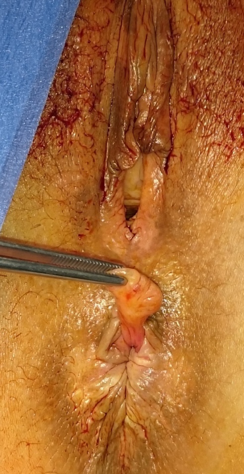 Φλεγμονώδης κλοακογενής πολύποδας με φλεγμονώδες ινομυϊκό στρώμα και υπερπλαστικό επιθήλιο (Ευγενική παραχώρηση Dr. V. Penopoulos)