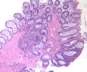 Φλεγμονώδης κλοακογενής πολύποδας με φλεγμονώδες ινομυϊκό στρώμα και υπερπλαστικό επιθήλιο (Ευγενική παραχώρηση Dr. V. Penopoulos)