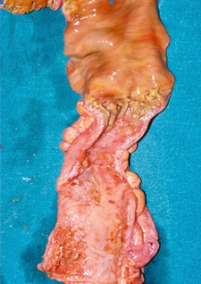Details of the ischemic lesions of the colon (Courtesy Dr. V. Penopoulos)