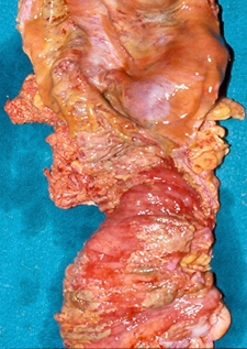 Visible non-contiguous ischemic lesions of the colon (Courtesy Dr. V. Penopoulos)