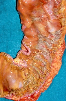 Perivenous lymphocytic infiltration and venous occlusion (Courtesy Dr. V. Penopoulos)