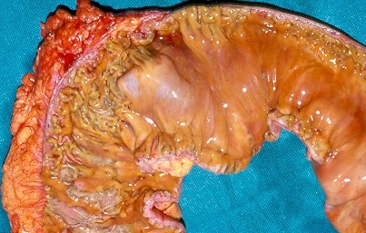 Perivenous lymphocytic infiltration and venous occlusion (Courtesy Dr. V. Penopoulos)