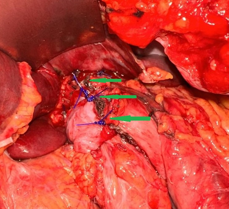 Abdominal computed tomography. Atonic, distended stomach, filled with food residue (Courtesy Dr. V. Penopoulos)