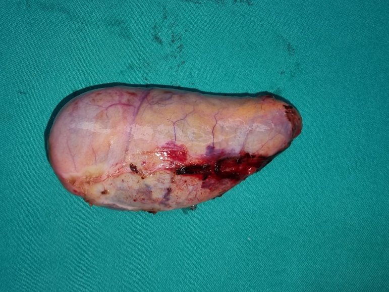Subtotal gastrectomy specimen (Courtesy Dr. V. Penopoulos)