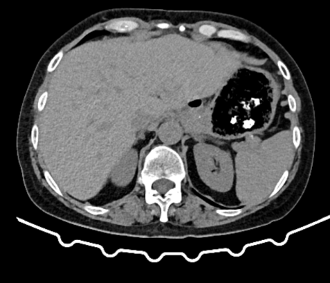 Electron micrograph demonstrating the SIP syncytium in the guinea pig stomach. Panel A, Mitsui & Komuro. Cell Tissue Res 2002;309:219-227; Panel B-D, Sung TS, et al. J Physiol 2018;596:1549-1574; Panel E, Sanders KM et al. J Physiol 2010;588:4621-4639 (Courtesy Dr. V. Penopoulos)