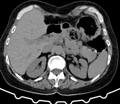 Electron micrograph demonstrating the SIP syncytium in the guinea pig stomach. Panel A, Mitsui & Komuro. Cell Tissue Res 2002;309:219-227; Panel B-D, Sung TS, et al. J Physiol 2018;596:1549-1574; Panel E, Sanders KM et al. J Physiol 2010;588:4621-4639 (Courtesy Dr. V. Penopoulos)