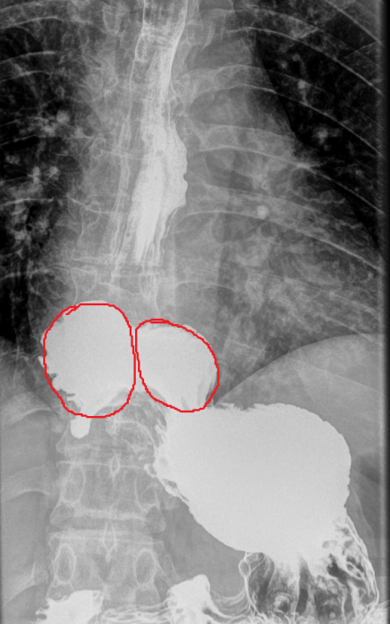 Barium esophagography. Esophageal achalasia (Courtesy Dr. V. Penopoulos)
