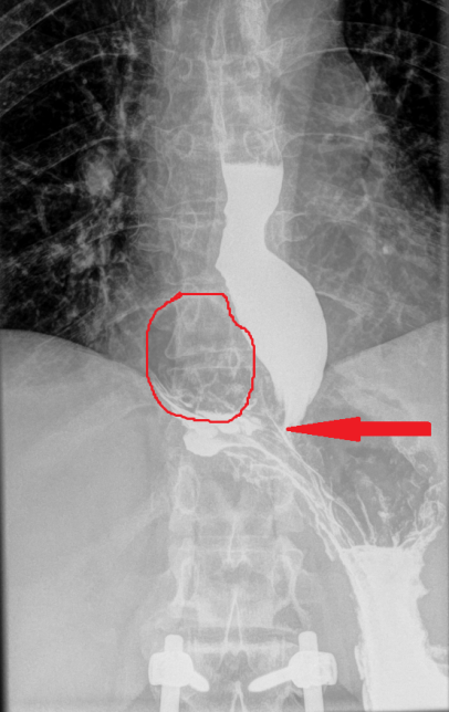 Hiatal hernia defect. Green arrow - Right lung (Courtesy Dr. V. Penopoulos)