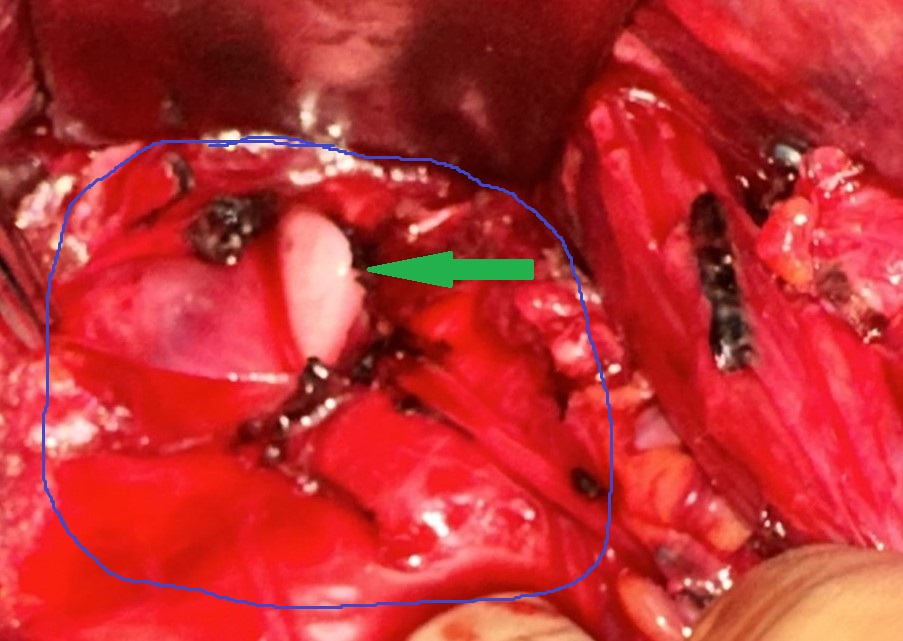 Hiatal hernia cavity and complete closure/repair without mesh (Courtesy Dr. V. Penopoulos)