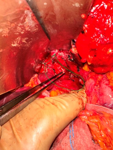 Separation of the esophagus from the hiatal hernia (Courtesy Dr. V. Penopoulos)