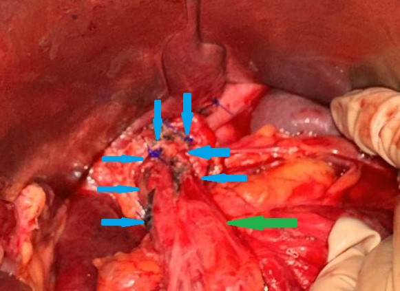 Long anterior Heller myotomy (Courtesy Dr. V. Penopoulos)