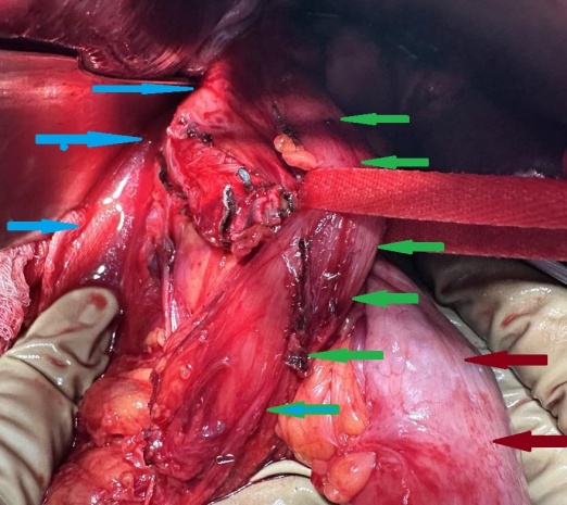 Nissen fundoplication (Courtesy Dr. V. Penopoulos)