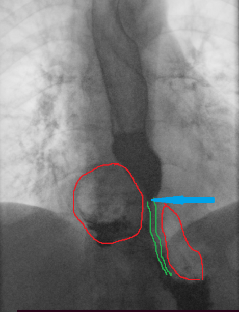 Cholecystectomy specimen (Courtesy Dr. V. Penopoulos)