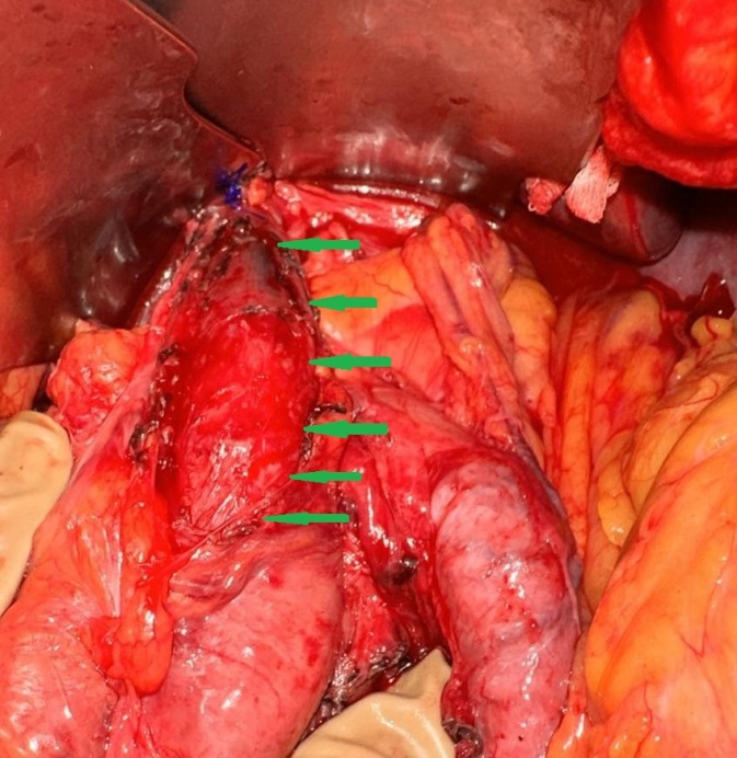 Postoperative barium esophagography. Smooth passage of contrast through the myotomy site (Courtesy Dr. V. Penopoulos)