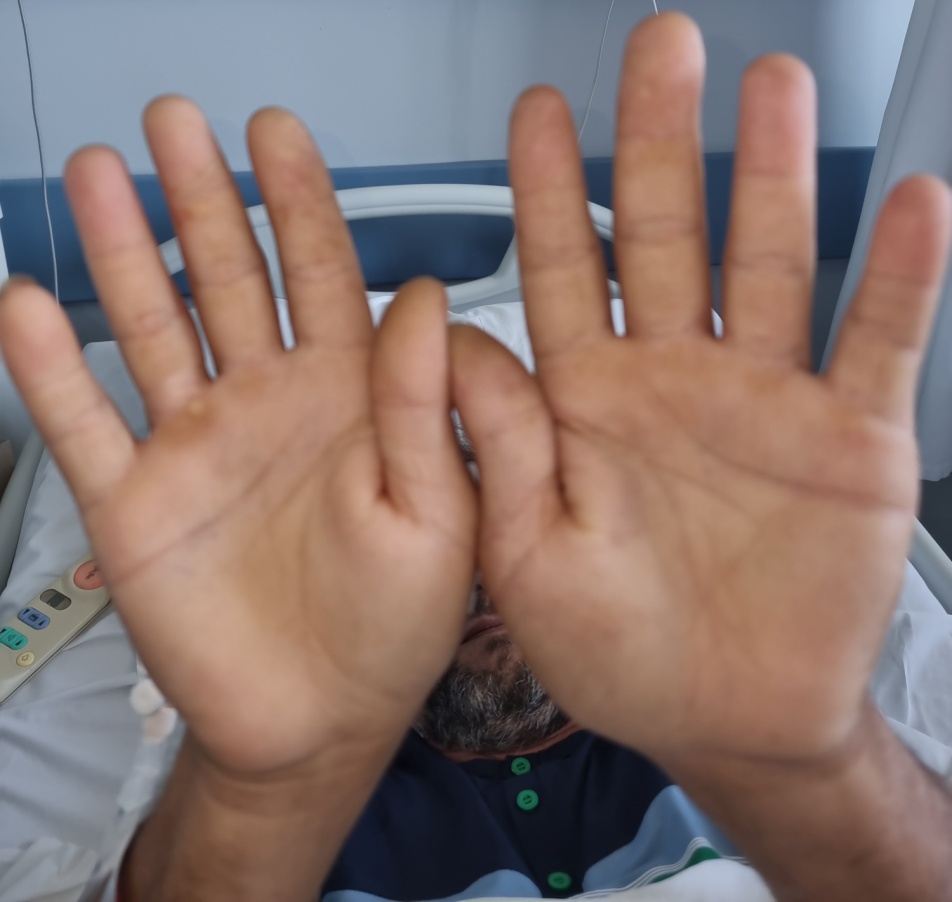 Το αριστερό κάτω άκρο εμφανίζεται σαφώς μεγαλύτερο, παχύτερο, οιδηματώδες, με πολυάριθμες ορατές, έντονα διατεταμένες φλέβες (Ευγενική παραχώρηση Dr. V. Penopoulos)