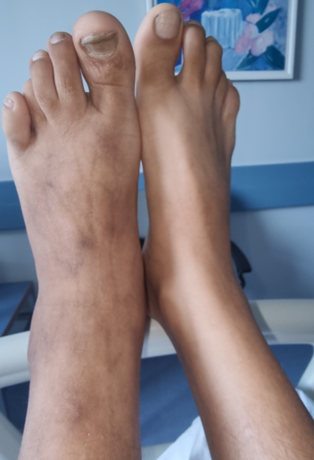 Το αριστερό κάτω άκρο εμφανίζεται σαφώς μεγαλύτερο, παχύτερο, οιδηματώδες, με πολυάριθμες ορατές, έντονα διατεταμένες φλέβες (Ευγενική παραχώρηση Dr. V. Penopoulos)