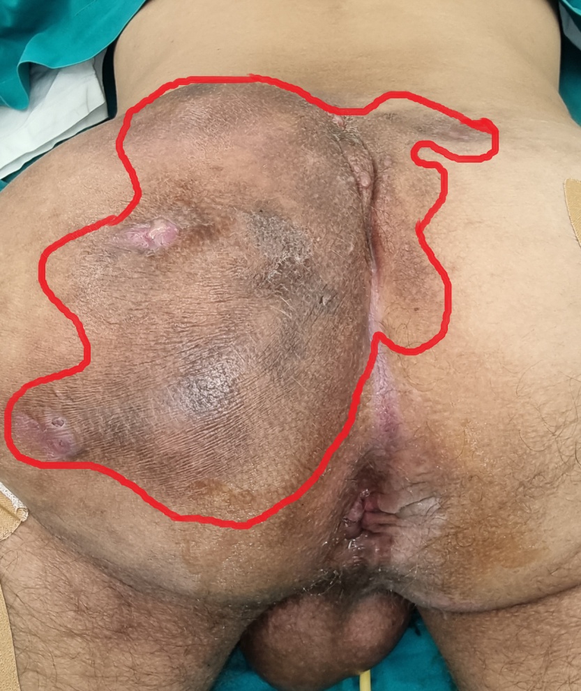 En bloc εκτομή φλεγμονώδους μάζας (Ευγενική παραχώρηση Dr. V. Penopoulos)