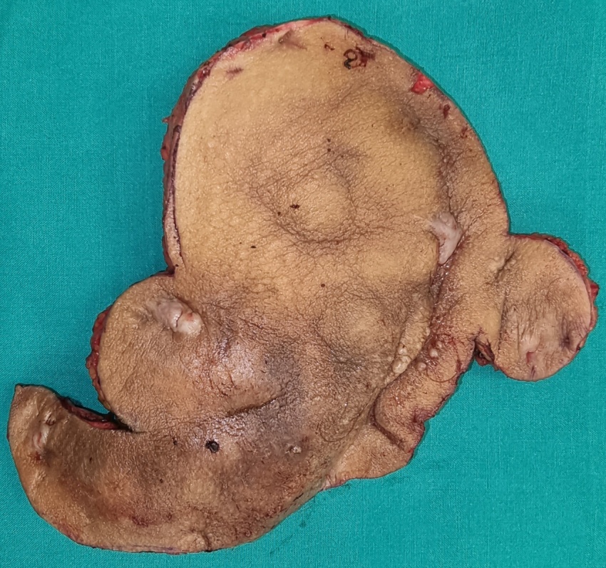 Αποκατάσταση χειρουργικού τραύματος. Το κεντρικό τμήμα αφέθηκε να επουλωθεί κατά δεύτερο σκοπό (Ευγενική παραχώρηση Dr. V. Penopoulos)