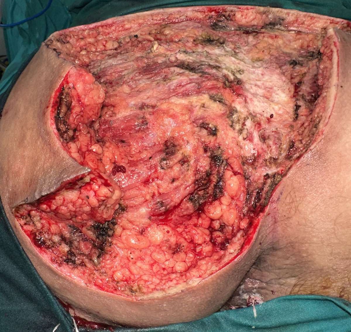 Πλήρης επούλωση 2 μήνες μετά την εγχείριση (Ευγενική παραχώρηση Dr. V. Penopoulos)