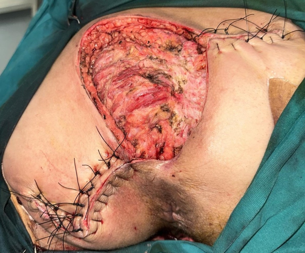 Αριστερός ημιθώρακας μεγαλύτερος από τον δεξιό (Ευγενική παραχώρηση Dr. V. Penopoulos)