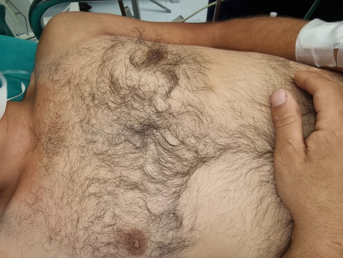 Το αριστερό κάτω άκρο εμφανίζεται σαφώς μεγαλύτερο, παχύτερο, οιδηματώδες, με πολυάριθμες ορατές, έντονα διατεταμένες φλέβες (Ευγενική παραχώρηση Dr. V. Penopoulos)