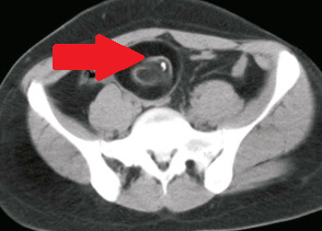 CT scan κοιλίας. Παρουσία ασβεστώσεων, κυστικο-συμπαγών περιοχών και λιπώδους ιστού, ενδεικτικά τερατώματος δεξιάς πλευράς (Ευγενική παραχώρηση Dr. V. Penopoulos)