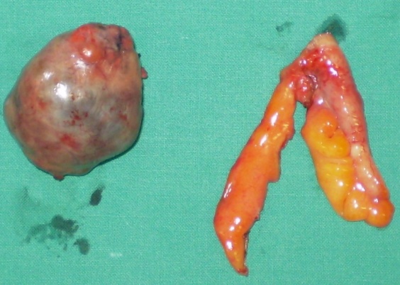 Χειρουργικά παρασκευάσματα ώριμου τερατώματος και σκωληκοειδούς (Ευγενική παραχώρηση Dr. V. Penopoulos)