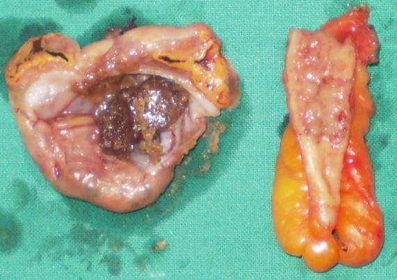 Πράσινο βέλος: Λιπώδης ιστός. Μοβ βέλος: Σμηγματογόνοι αδένες (Ευγενική παραχώρηση Dr. V. Penopoulos)