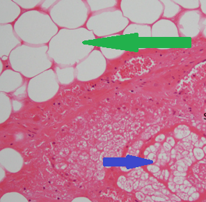 Πράσινα βέλη: Τρίχες. Μπλε βέλος: Ινώδες στρώμα (Ευγενική παραχώρηση Dr. V. Penopoulos)