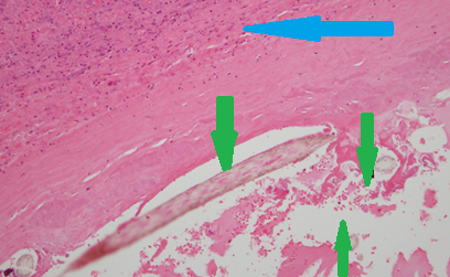 Πράσινα βέλη: Τρίχες. Μπλε βέλος: Ινώδες στρώμα (Ευγενική παραχώρηση Dr. V. Penopoulos)