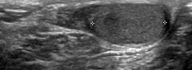Abdominal CT. Red arrow: Ectopic testis (Courtesy Dr. V. Penopoulos)