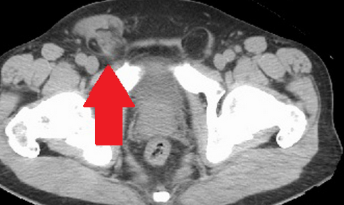 Right orchiectomy specimen. Atrophy of the testicular parenchyma is evident (Courtesy Dr. V. Penopoulos)