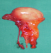 Right orchiectomy specimen. Atrophy of the testicular parenchyma is evident (Courtesy Dr. V. Penopoulos)