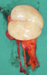 Right orchiectomy specimen. Atrophy of the testicular parenchyma is evident (Courtesy Dr. V. Penopoulos)