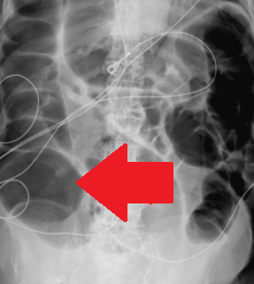 CT scan κοιλίας. Ψευδο-απόφραξη κόλου (Ευγενική παραχώρηση Dr. V. Penopoulos)