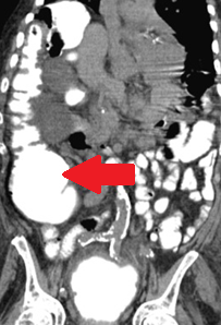 CT scan κοιλίας. Ψευδο-απόφραξη κόλου (Ευγενική παραχώρηση Dr. V. Penopoulos)
