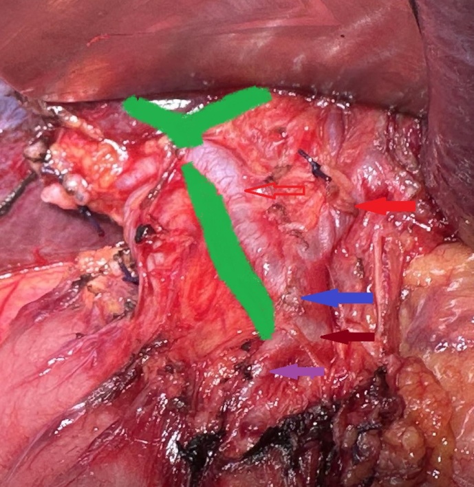 Compression of the common hepatic duct by the right hepatic artery is evident. Red arrows: right and left hepatic artery. Blue arrow: proper hepatic artery. Brown arrow: common hepatic artery. Purple arrow: gastroduodenal artery (Courtesy Dr. V. Penopoulos).