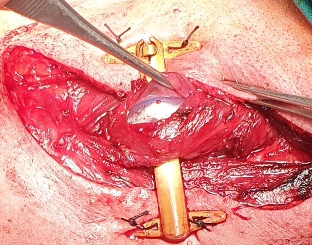 Οισοφαγοστομία. Αποκλεισμός κατώτερου οισοφάγου (Ευγενική παραχώρηση Dr. V. Penopoulos)