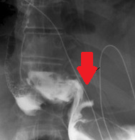 Γαστρογραφίνη. Διάτρηση κατώτερου οισοφάγου (Ευγενική παραχώρηση Dr. V. Penopoulos)