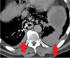 CT θώρακα. Αμφοτερόπλευρες υπεζωκοτικές συλλογές, εντονότερες αριστερά (Ευγενική παραχώρηση Dr. V. Penopoulos)