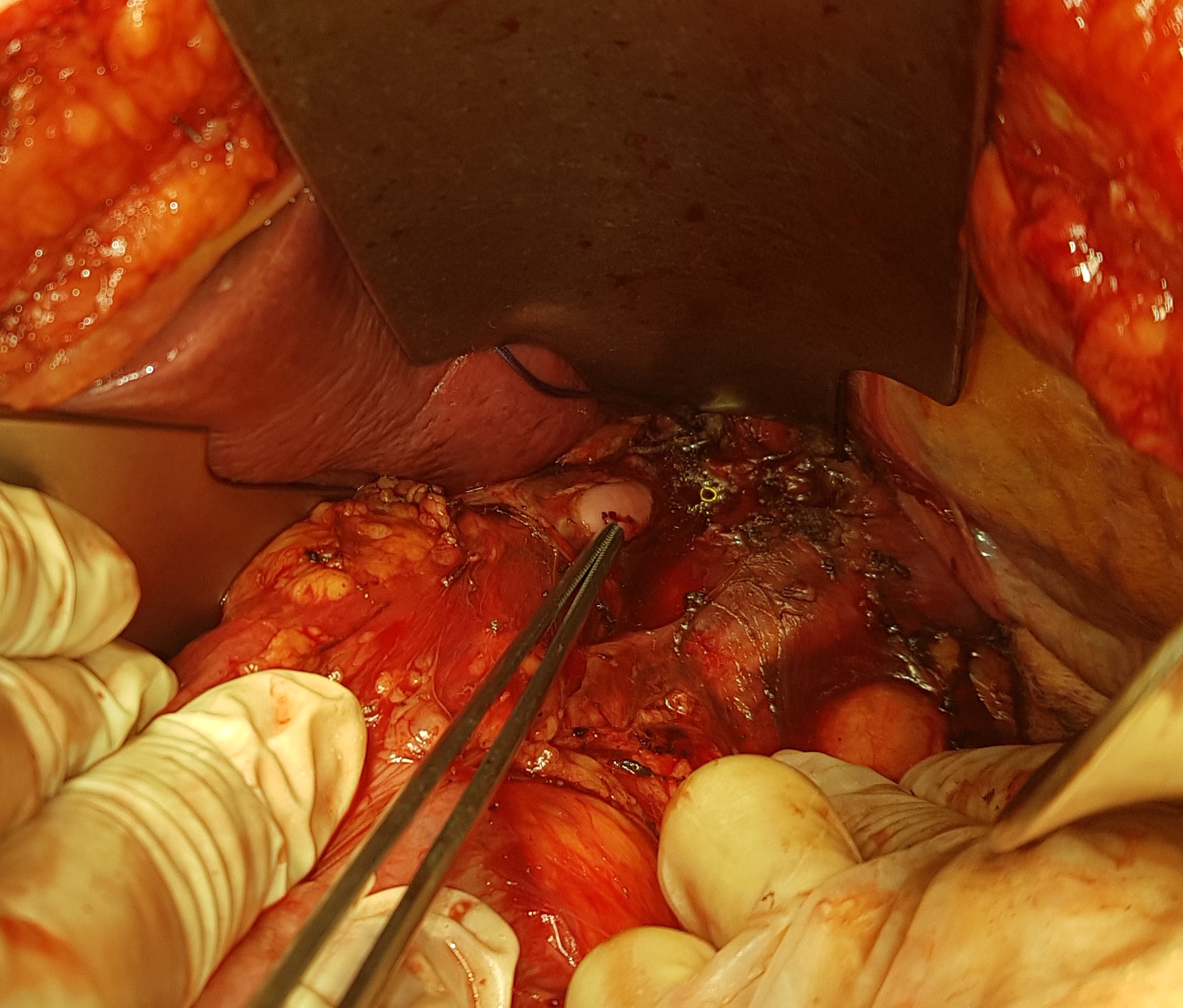 Λαβίδα στη θέση διάτρησης κατώτερου οισοφάγου (Ευγενική παραχώρηση Dr. V. Penopoulos)