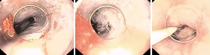 Ενδοσκοπική τοποθέτηση stent (Ευγενική παραχώρηση Dr. V. Penopoulos)