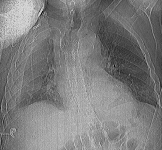 Οισοφαγοστομία. Αποκλεισμός κατώτερου οισοφάγου (Ευγενική παραχώρηση Dr. V. Penopoulos)