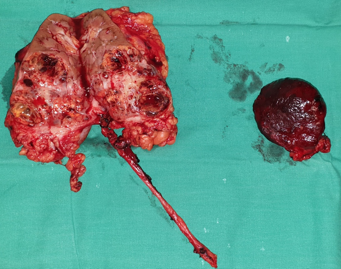 Papillary thyroid carcinoma (Courtesy Dr. V. Penopoulos)