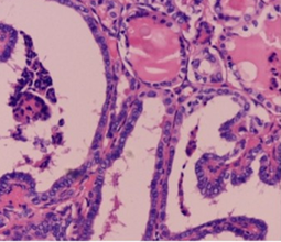 Follicular thyroid carcinoma (Courtesy Dr. V. Penopoulos)