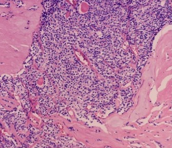 Clear cell carcinoma of the left kidney (Courtesy Dr. V. Penopoulos)